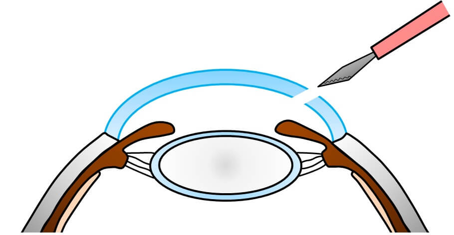 白内障 手術の流れ1
