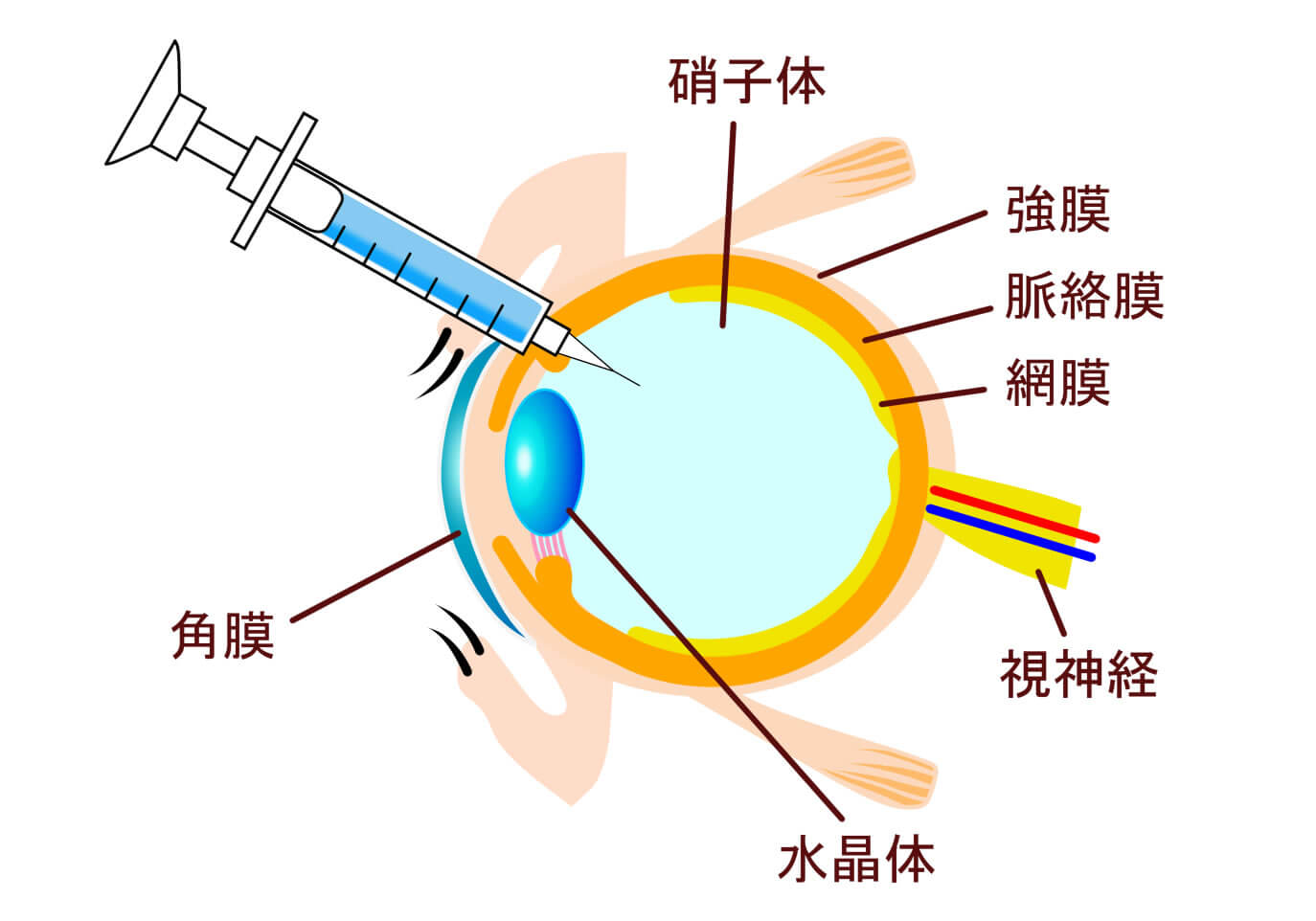 硝子体注射